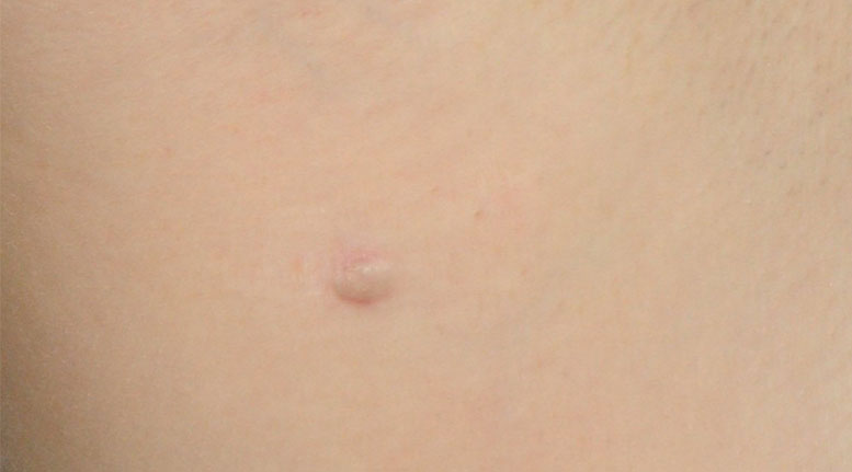 Huge Bump on inner thigh. inside stretch mark?? (Photo included