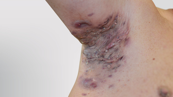 What could be the cause of an inner-thigh scar from no trauma? (photos)