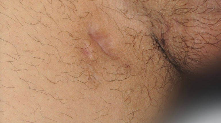 Had this huge dark lump on my inner thigh for about 6 months now