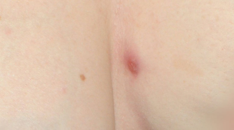 Bumps on inner thigh ? Is This HS ?? : r/Hidradenitis